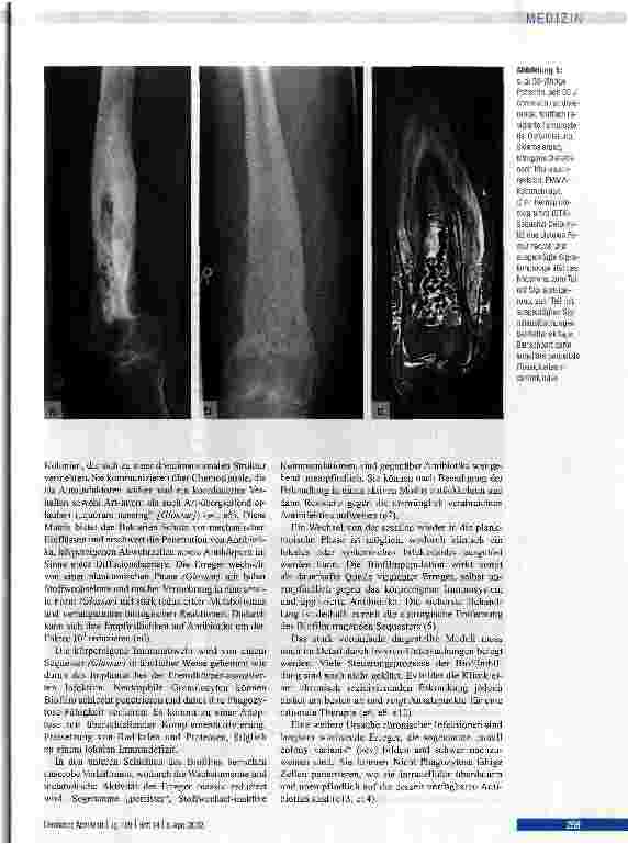 Vorschauseite 3: Behandlungsalgorithmen der chronischen Osteomyelitis