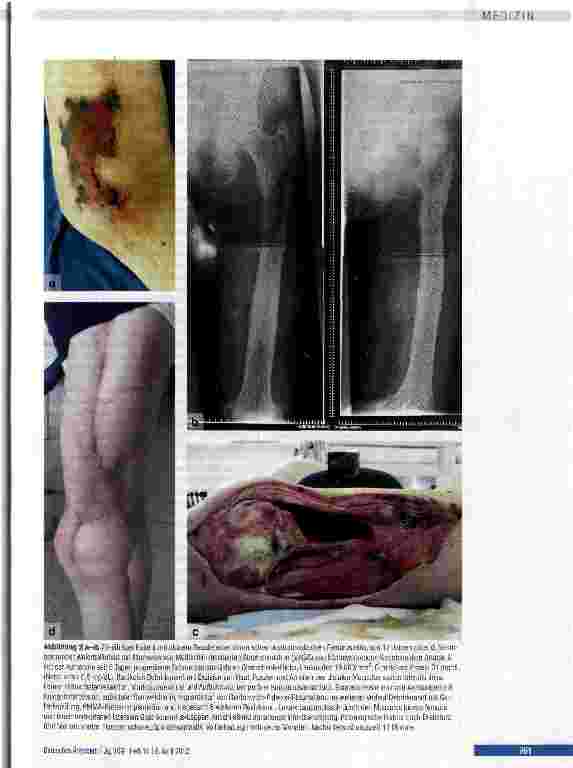 Vorschauseite 5: Behandlungsalgorithmen der chronischen Osteomyelitis