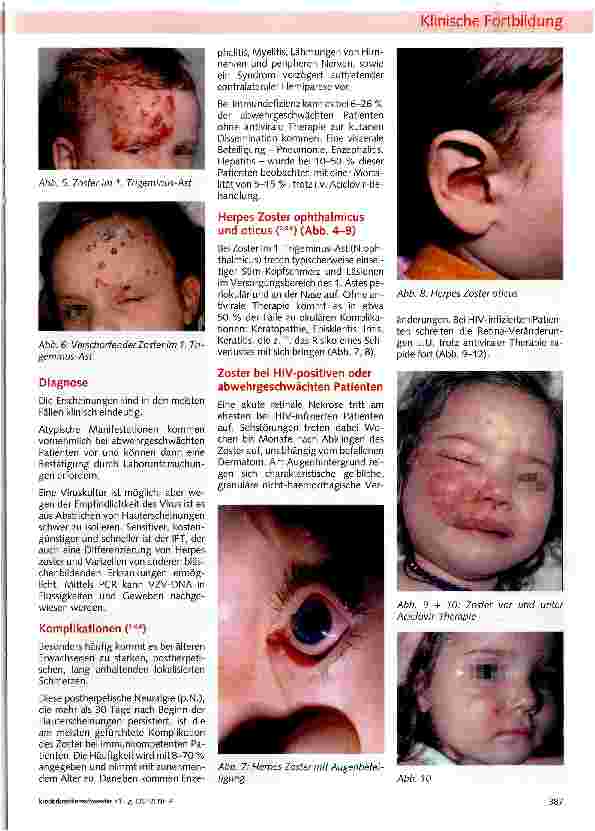 Vorschauseite 2: Herpes Zoster („Gürtelrose)