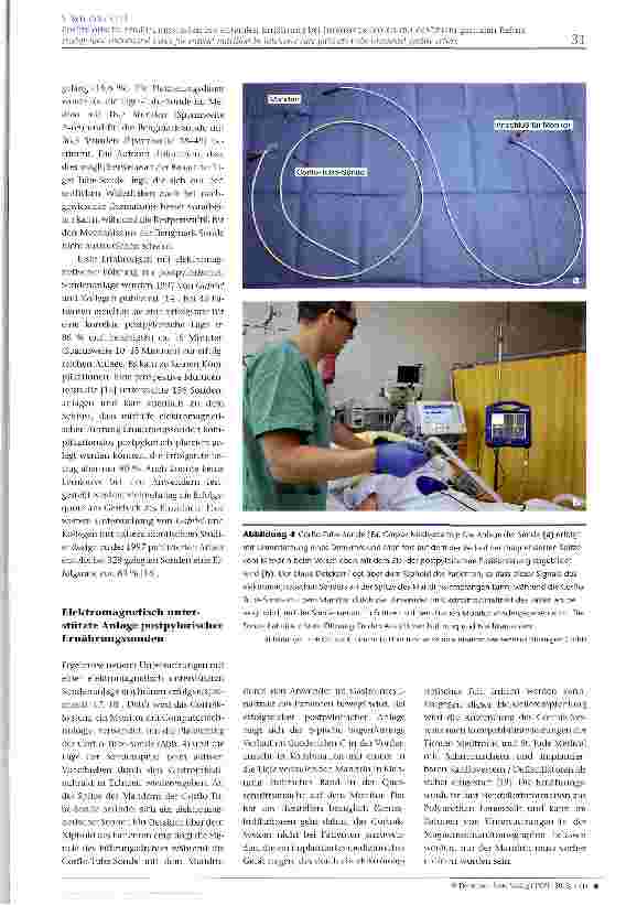 Vorschauseite 4: Postpylorische Ernährungssonden zur enteralen Ernährung bei Intensivpatienten mit erhöhtem gastralen Reflux