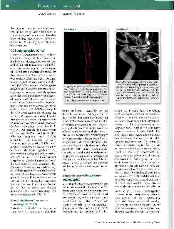 Vorschauseite 5: Diagnose und Therapie der atraumatischen Subarachnoidalblutung