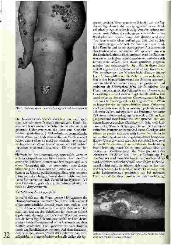 Vorschauseite 2: Die Schuppenflechte (Psoriasis vulgaris)
