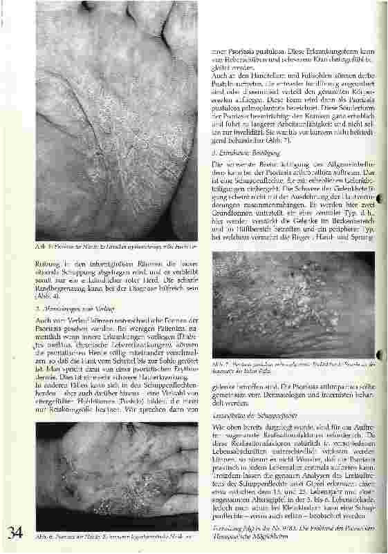 Vorschauseite 4: Die Schuppenflechte (Psoriasis vulgaris)