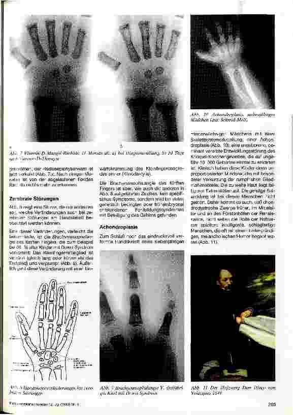 Vorschauseite 4: Das Röntgenbild der Hand Diagnostische Möglichkeiten beim Kind
