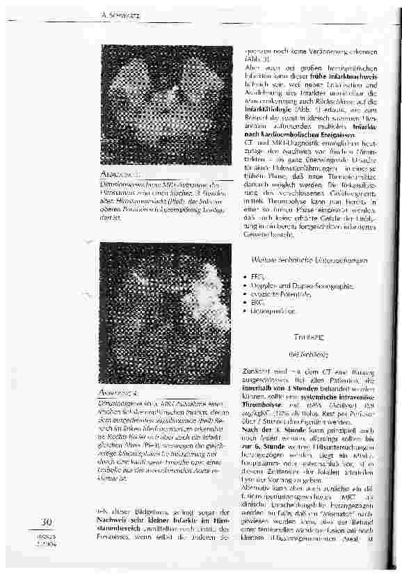 Vorschauseite 6: LEITSYMPTOM AKUTE HALBSEITENLÄHMUNG