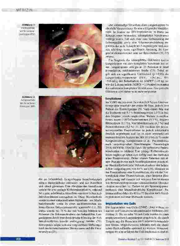 Vorschauseite 4: Endoskopische Volumenreduktion bei COPD - eine kritische Bestandsaufnahme