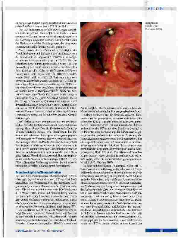 Vorschauseite 5: Endoskopische Volumenreduktion bei COPD - eine kritische Bestandsaufnahme