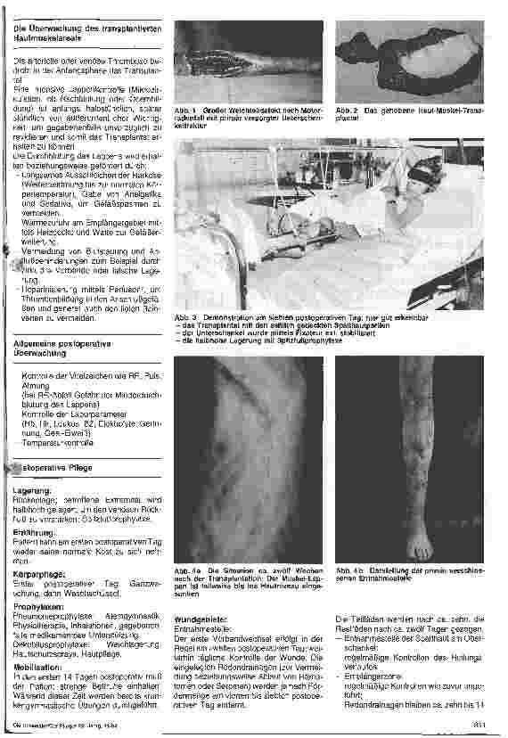 Vorschauseite 2: Die Pflege nach der Transplantation eines mikrochirurgisch angeschlossenen myocutanen Latissimus-dorsi-Lappens