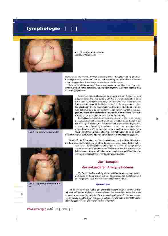 Vorschauseite 2: Behandlung des sekundären Armlymphödems nach Mammaamputation