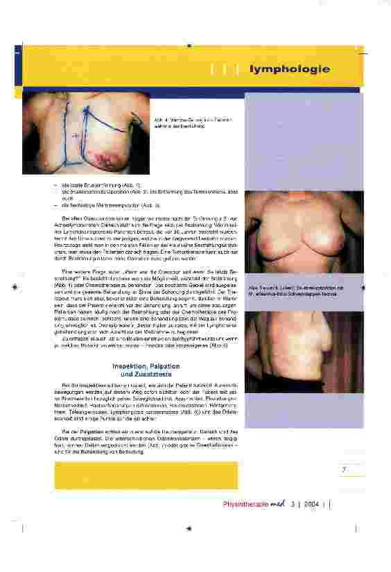 Vorschauseite 3: Behandlung des sekundären Armlymphödems nach Mammaamputation