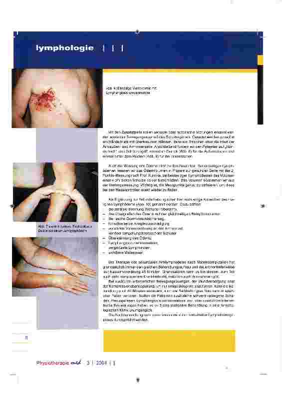 Vorschauseite 4: Behandlung des sekundären Armlymphödems nach Mammaamputation