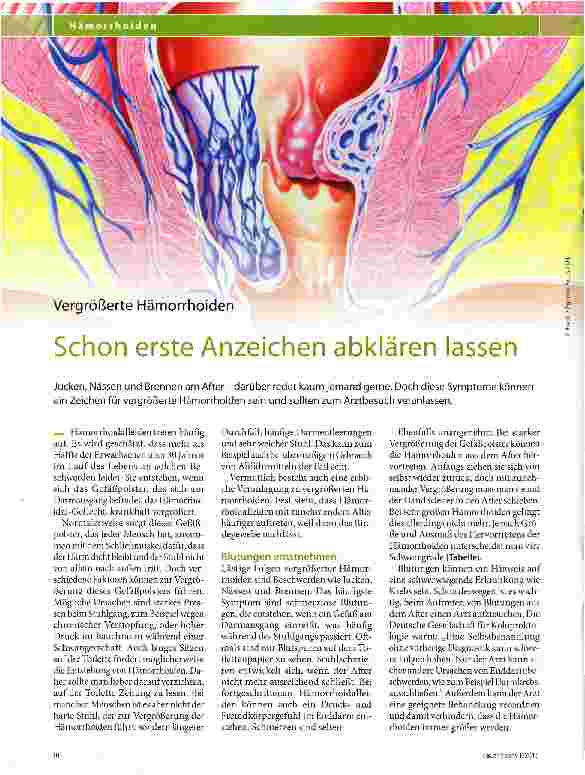 Vorschauseite 1: Vergrößerte Hämorrhoiden Schon erste Anzeichen abklären lassen