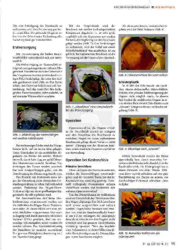 Vorschauseite 4: Bauchwanddefekte: Gastroschisis und Omphalozele