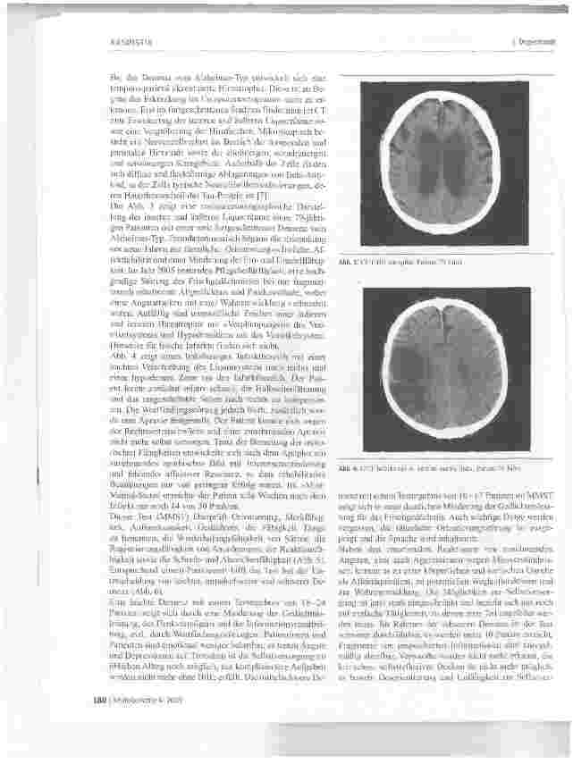 Vorschauseite 3: Demenz - Gedanken zu Symptomatologie und sekundärer Prävention