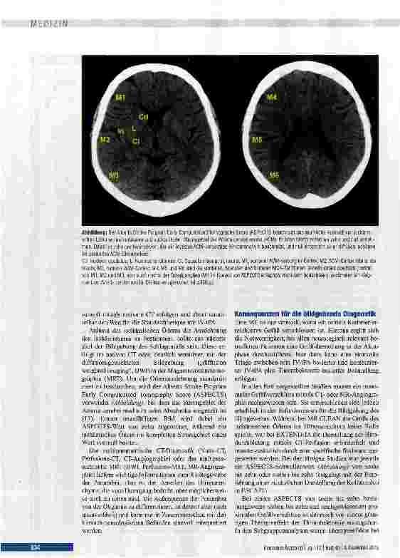 Vorschauseite 5: Mechanische Thrombektomie bei Schlaganfall