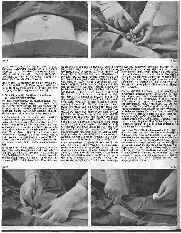 Vorschauseite 3: Peritonealdialyse