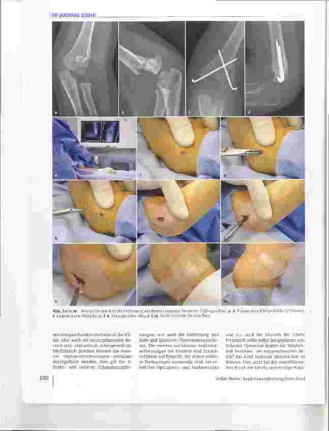 Vorschauseite 5: Implantatentfernung beim Kind