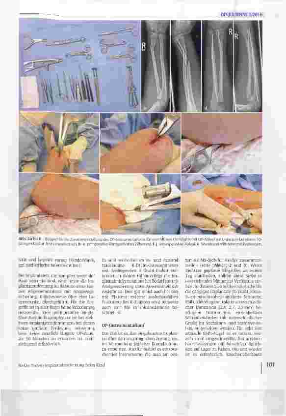 Vorschauseite 6: Implantatentfernung beim Kind