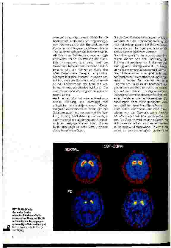Vorschauseite 3: Das Parkinson-Syndrom