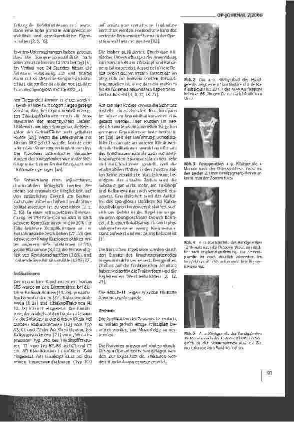 Vorschauseite 2: Norian SRS als Knochenersatzstoff - Indikationen, Technik und Komplikationen