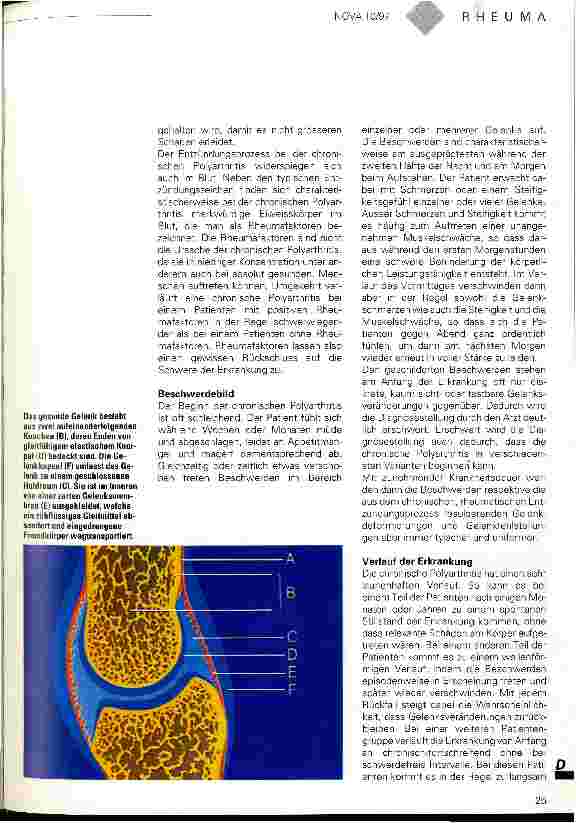 Vorschauseite 2: Ein Leben mit dem Schmerz Die chronische Polyathritis