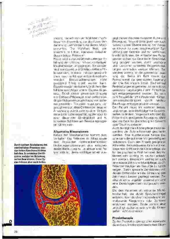Vorschauseite 5: Ein Leben mit dem Schmerz Die chronische Polyathritis