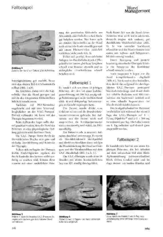 Vorschauseite 3: Behandlung oberflächlicher und tiefdermaler Verbrennungen mit dem V.A.C.®-Therapie Handschuh