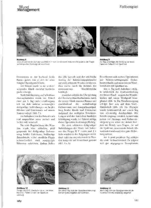 Vorschauseite 4: Behandlung oberflächlicher und tiefdermaler Verbrennungen mit dem V.A.C.®-Therapie Handschuh