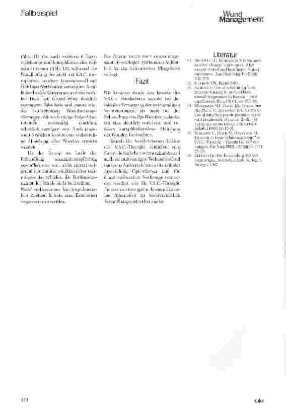 Vorschauseite 5: Behandlung oberflächlicher und tiefdermaler Verbrennungen mit dem V.A.C.®-Therapie Handschuh