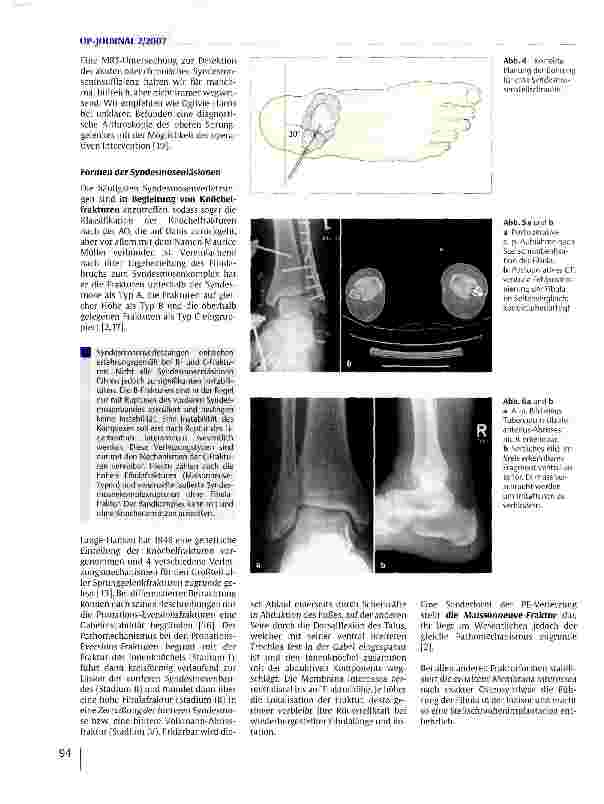 Vorschauseite 5: Syndesmosenverletzungen