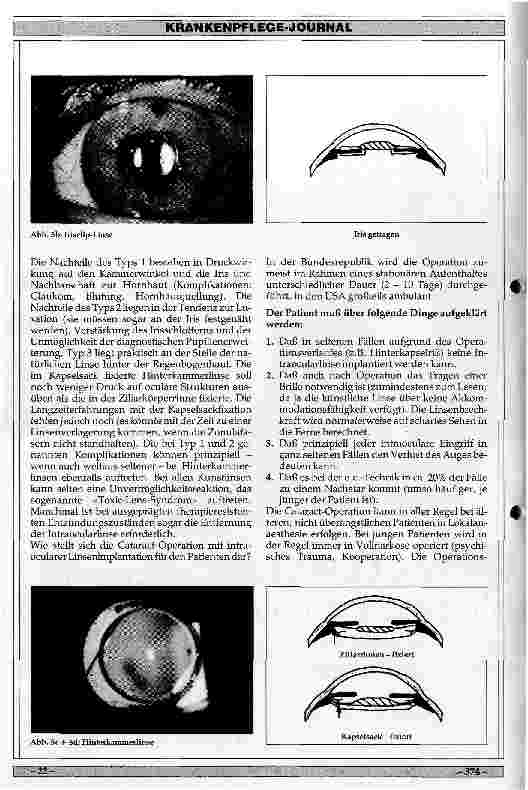 Vorschauseite 4: Klinik, Indikation und Ergebnisse der Intraocularlinsenimplantation