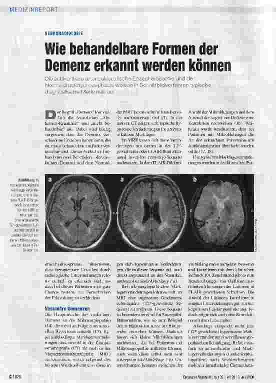 Vorschauseite 1: Wie behandelbare Formen der Demenz erkannt werden können