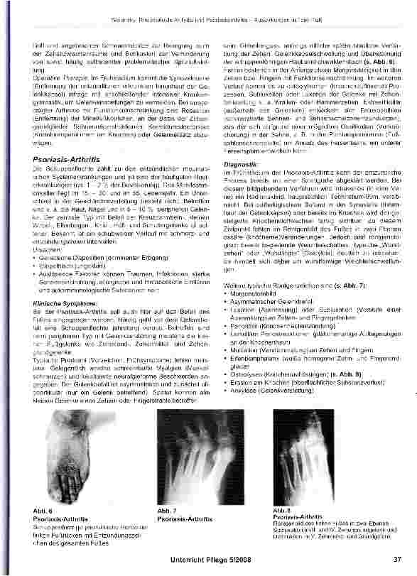 Vorschauseite 4: Rheumatoide Arthritis und Psoriasisarthritis Auswirkungen auf den Fuß