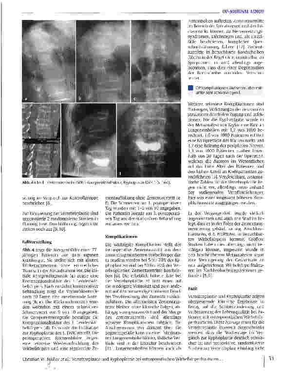Vorschauseite 4: Vertebroplastie und Kyphoplastie bei osteoporotischen Wirbelkörperfrakturen: Indikationen, Technik, Ergebnisse und Komplikationen
