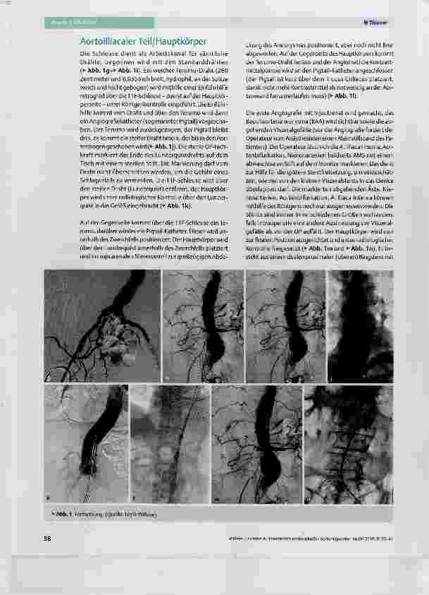 Vorschauseite 4: Fenestrierte endovaskuläre Aortenreparatur