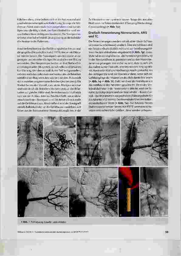 Vorschauseite 5: Fenestrierte endovaskuläre Aortenreparatur