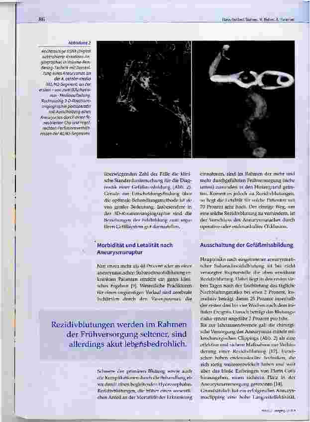 Vorschauseite 3: Aneurysmaclipping nach Subarachnoidalblutung Braucht man das noch?