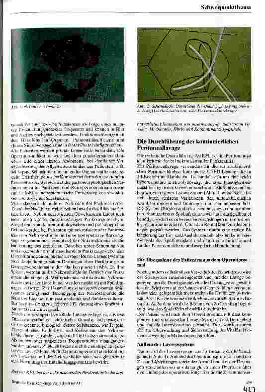 Vorschauseite 2: Peritoneallavage