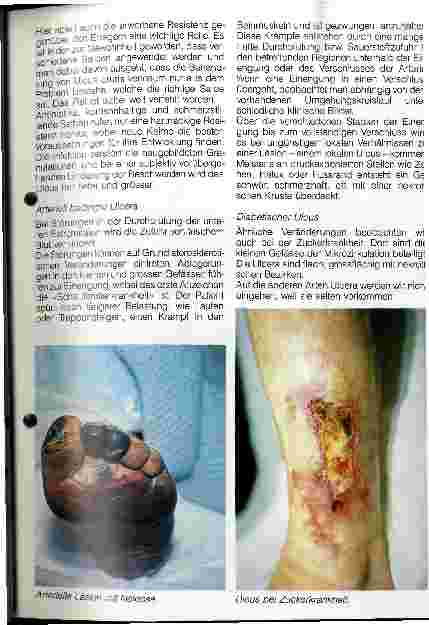 Vorschauseite 4: Das offene Bein - Ulcus cruris