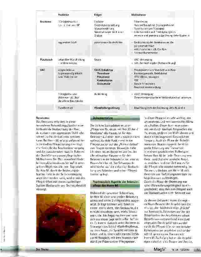 Vorschauseite 5: Pflege bei einem beatmeten Ileostomieträger bei zustand nach Platzbauch