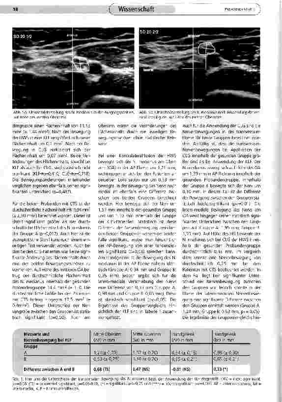 Vorschauseite 4: Bewegungsverhalten des N. medianus bei zervikalen Bewegungsmanövern