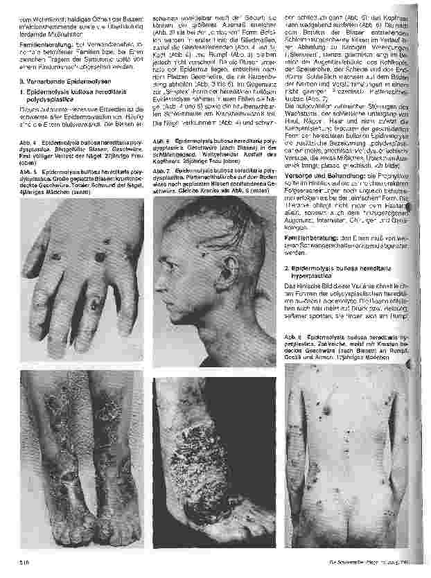 Vorschauseite 2: Hautärztliche Blick-Diagnose von Erbkrankheiten: Epidermolysis bullosa hereditaria