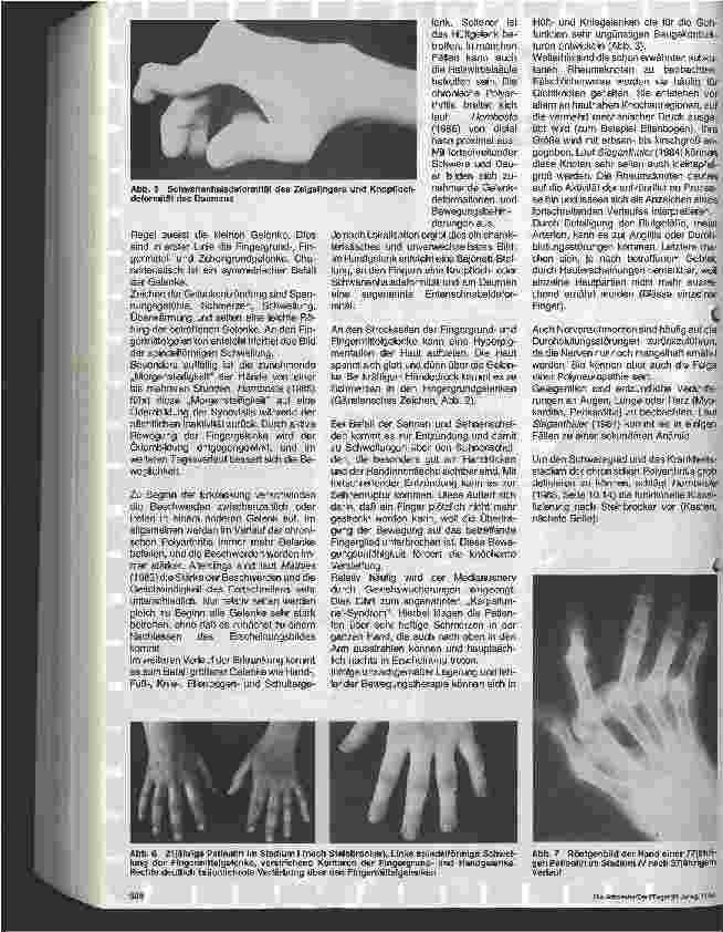 Vorschauseite 4: Der Patient mit chronischer Polyarthritis 1. Folge: Polyarthritis, die rheumatische Erkrankung
