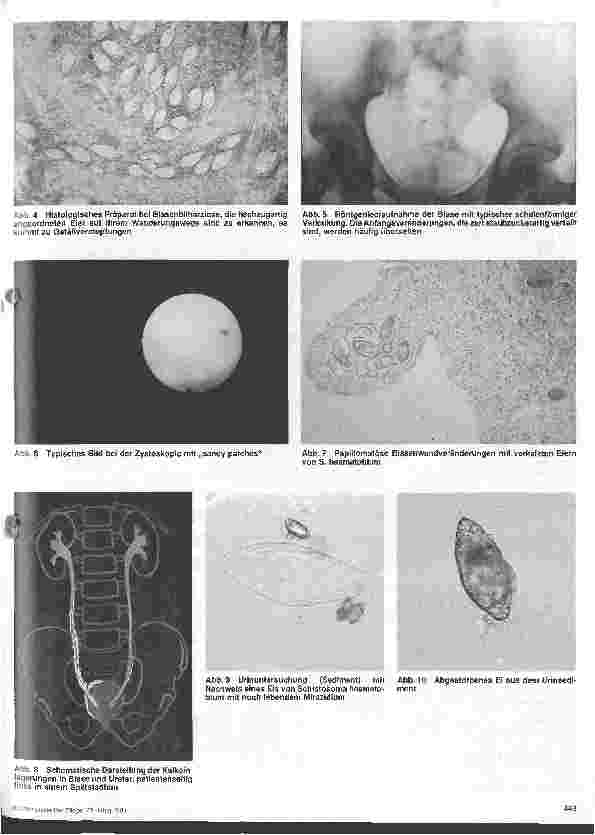 Vorschauseite 4: Wurminfektion - Schistosomiasis