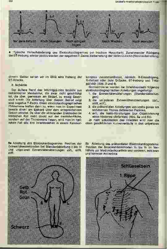 Vorschauseite 5: Der Herzinfarkt Ätiologie, Pathologie, Pathophysiologie und Klinik