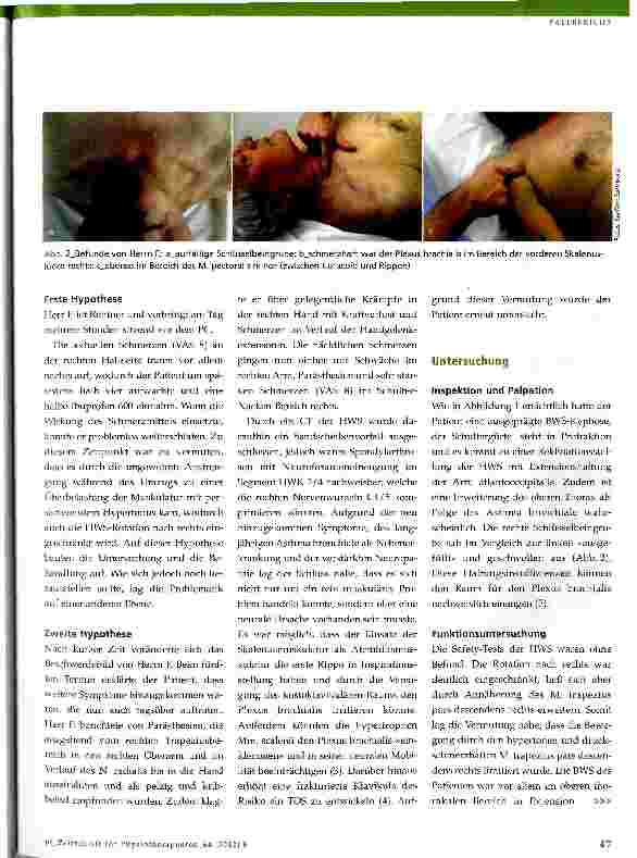 Vorschauseite 2: Thoracic-outlet-Syndrom (TOS) als mögliche Ursache für Nachtschmerzen