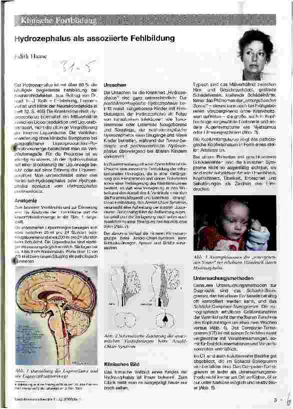 Vorschauseite 1: Hydrozephalus als assoziierte Fehlbildung