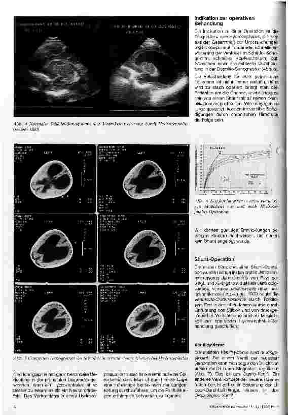 Vorschauseite 2: Hydrozephalus als assoziierte Fehlbildung