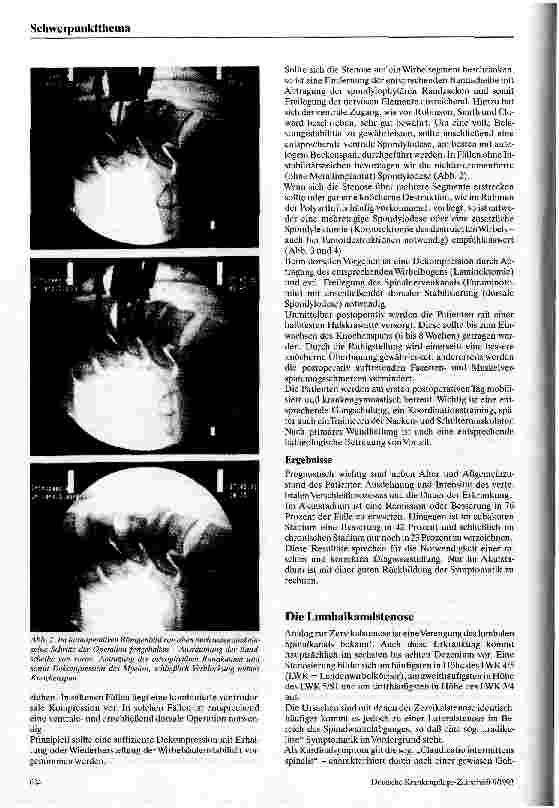 Vorschauseite 3: Die Spinalkanalstenose