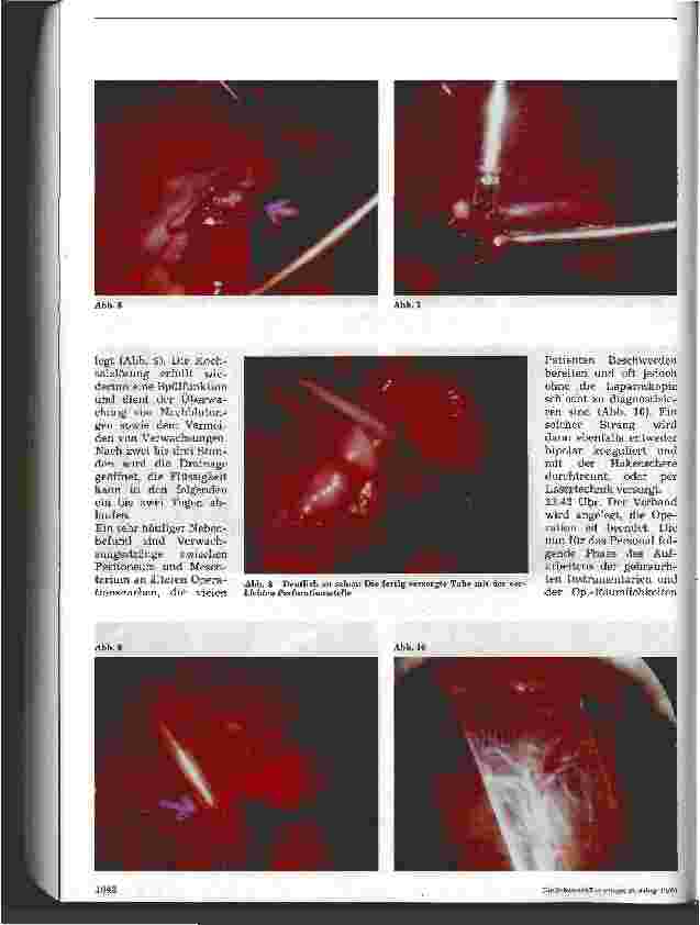 Vorschauseite 3: Minimal-invasive Chirurgie 6: Notfalloperation bei Eileiterschwangerschaft